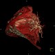 CTEPH, chronic thromboembolic pulmonary arterial hypertension, VRT: CT - Computed tomography